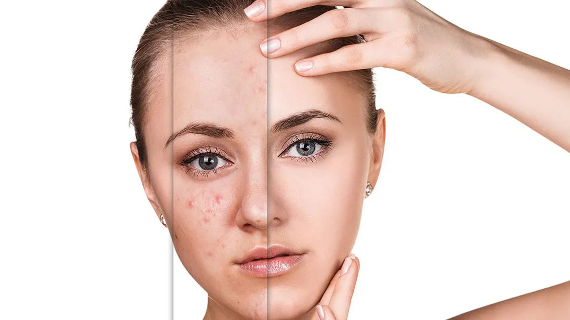Anti Pimple products تونر الوجه باليا سكين بيور 200 مل